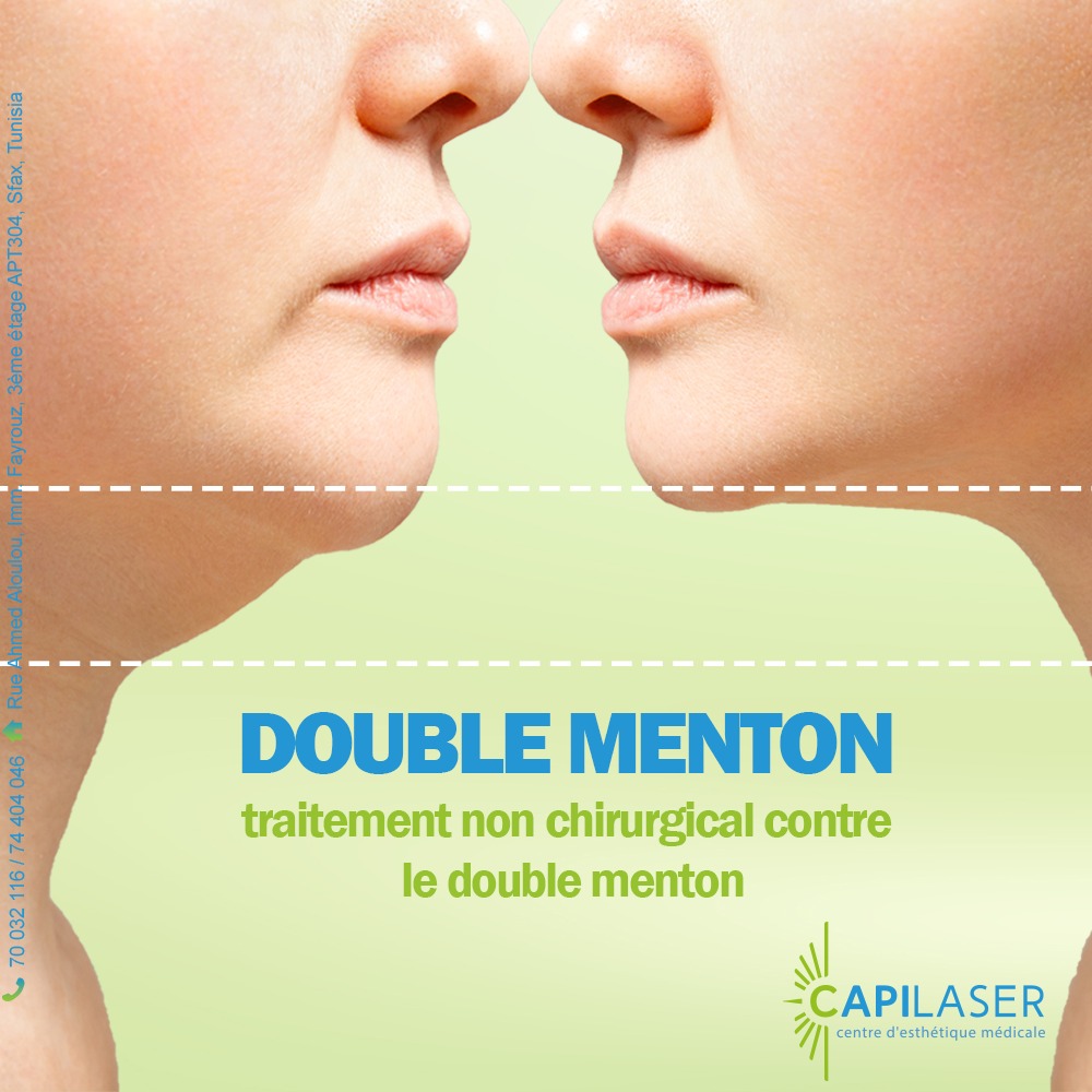 Capilaser - Dites adieu au double menton sans chirurgie ! Chez ...
