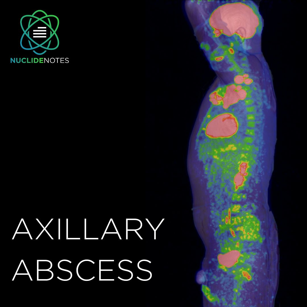 Nuclide Notes - ☢️ Axillary soft tissue abscess ☢️ in a... | Facebook