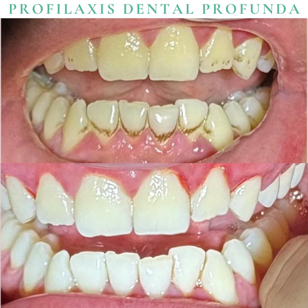Hada - 🦷Nuestro paciente ,antes y después de su profilaxis dental ...