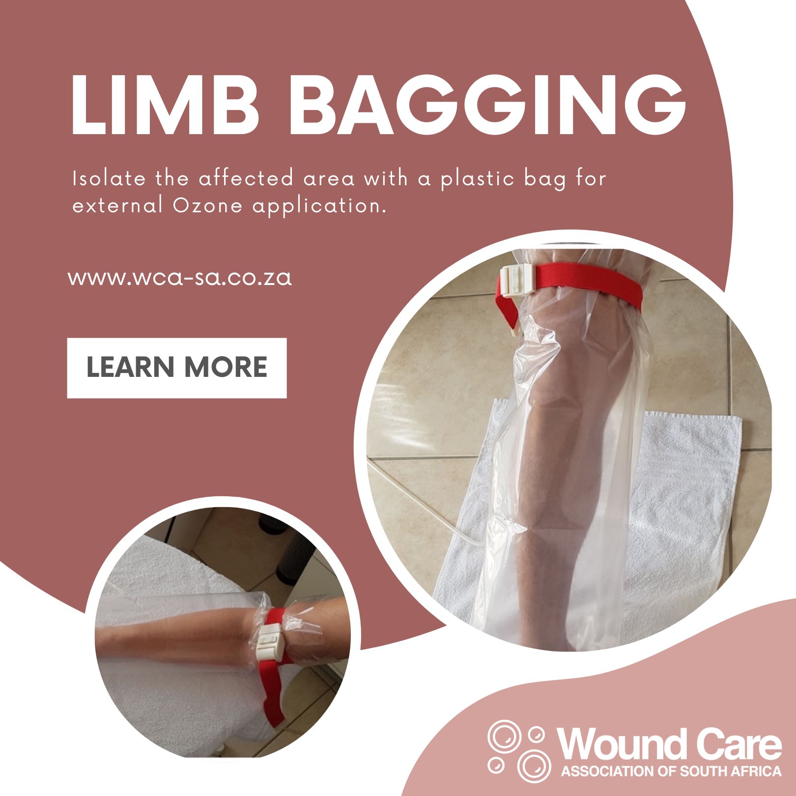 Wound - What is Limb Bagging? Limb-bagging introduces topical ozone gas ...