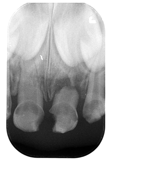 Dentforum - Periapical x-ray of 3 year old male patient...