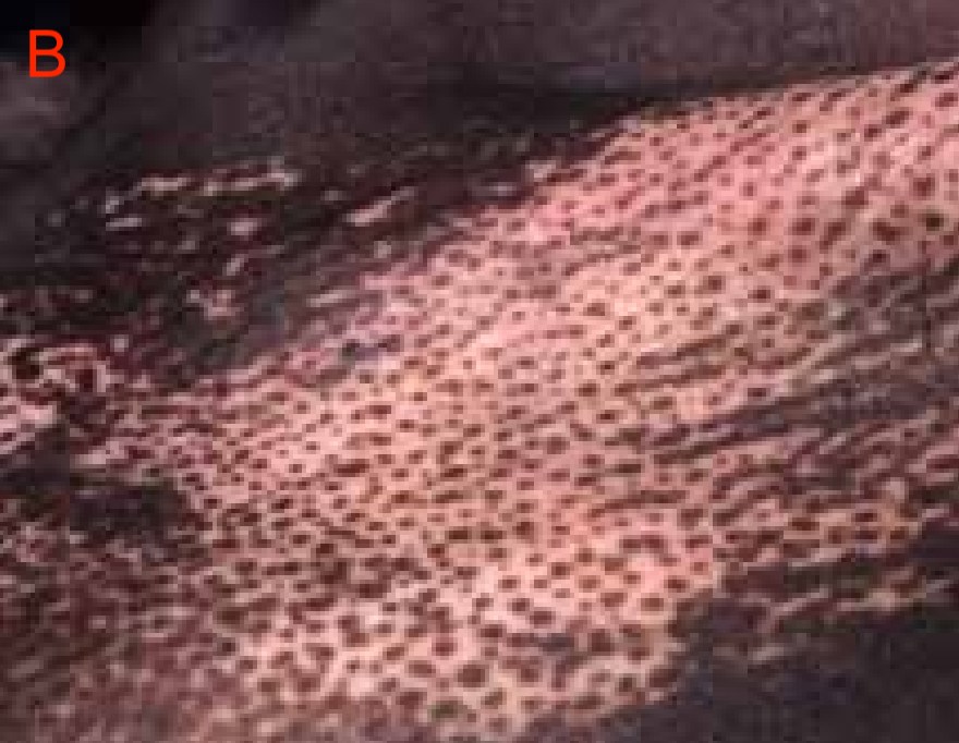 Dermatology - Bullous pemphigoid in a Nutshell: -Bullous pemphigoid is ...
