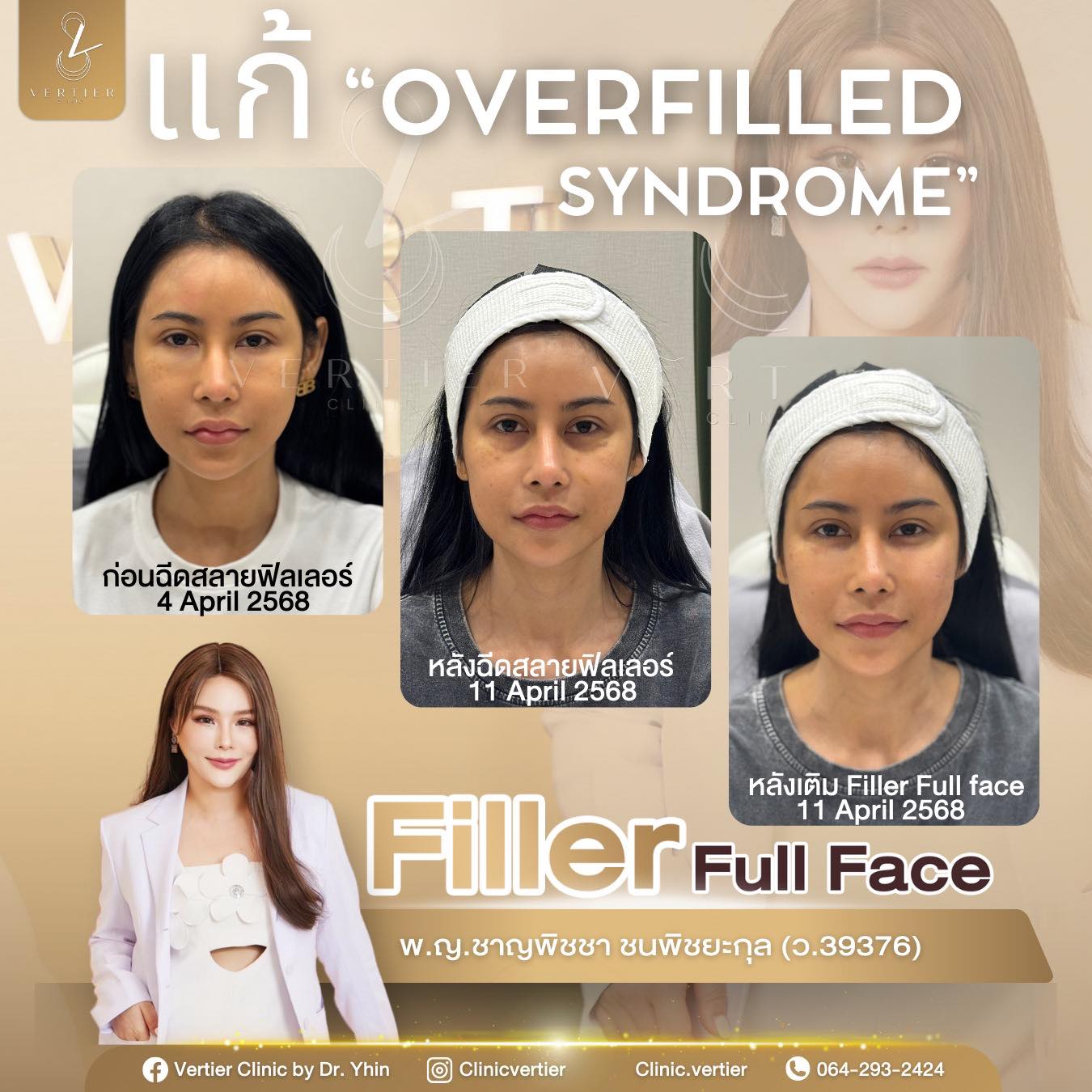 หน้าเปลี่ยนเพราะฟิลเลอร์มากเกินไป อาจไม่ใช่ความสวยที่ต้องการ…แก้เคส ...