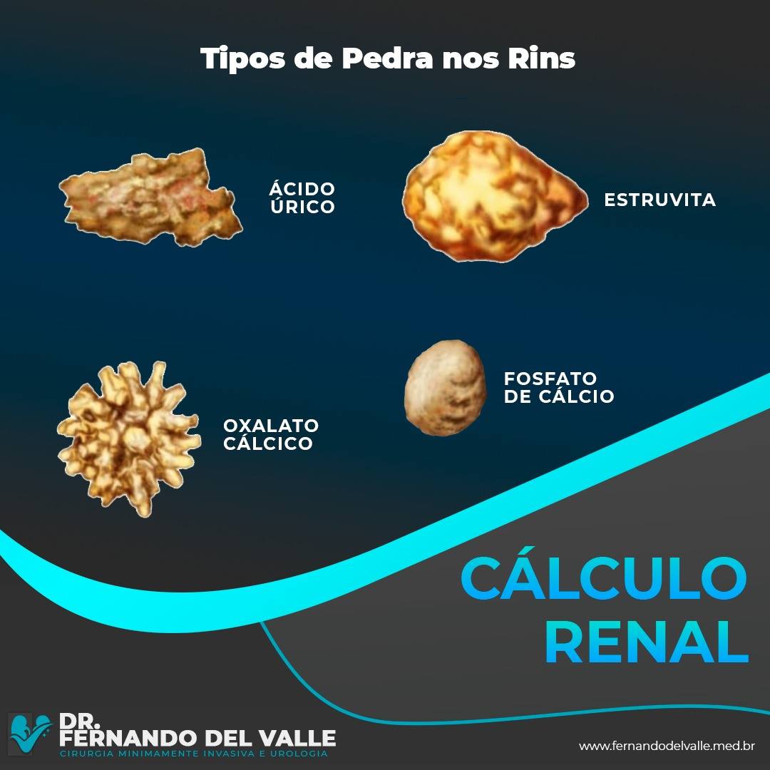 Dr. Fernando Del Valle - 🔷Existem 4 tipos de pedras nos rins: oxalato ...