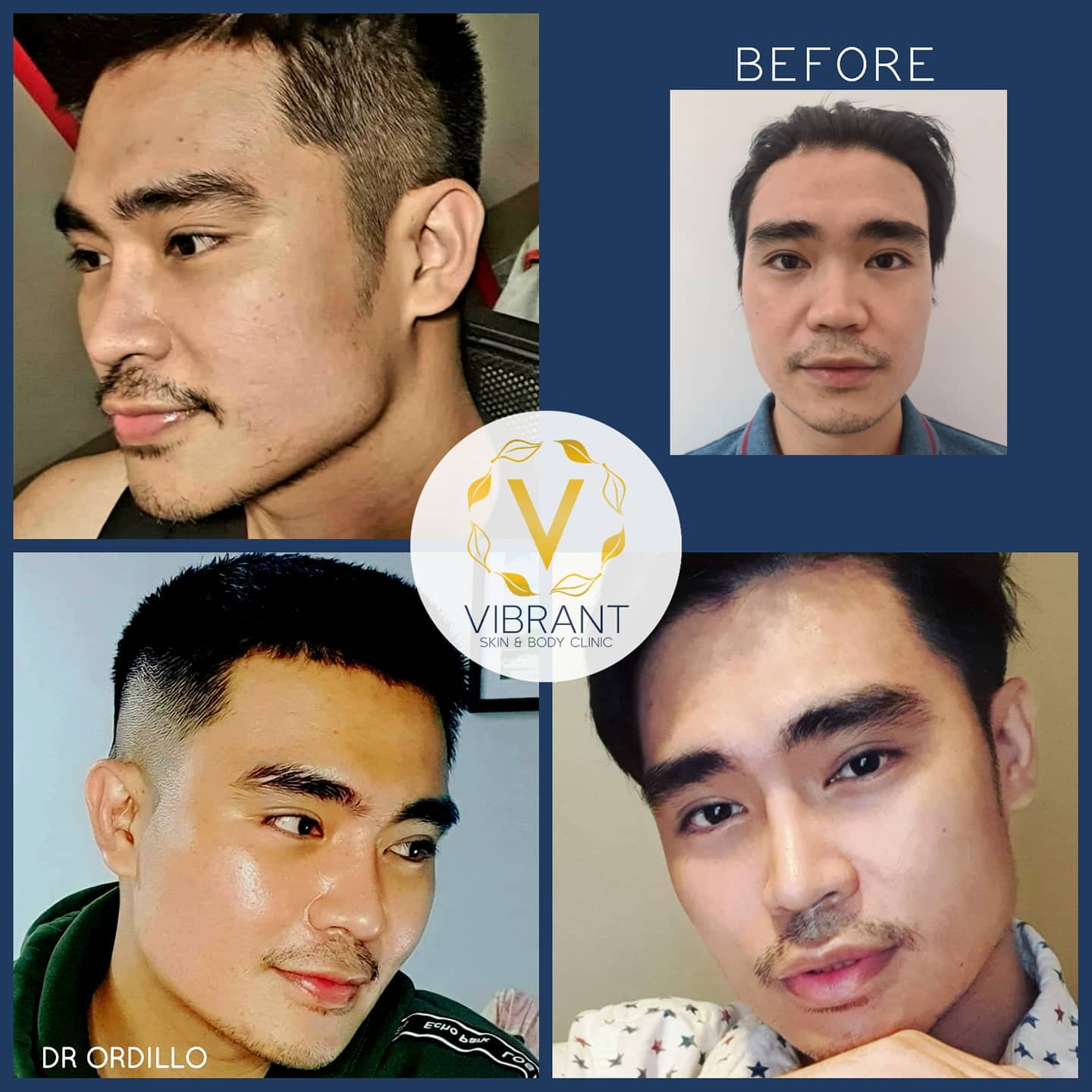 Vibrant Skin & Body Clinic by Dr. Ordillo - MALE RHINOPLASTY. 👃 Natural ...