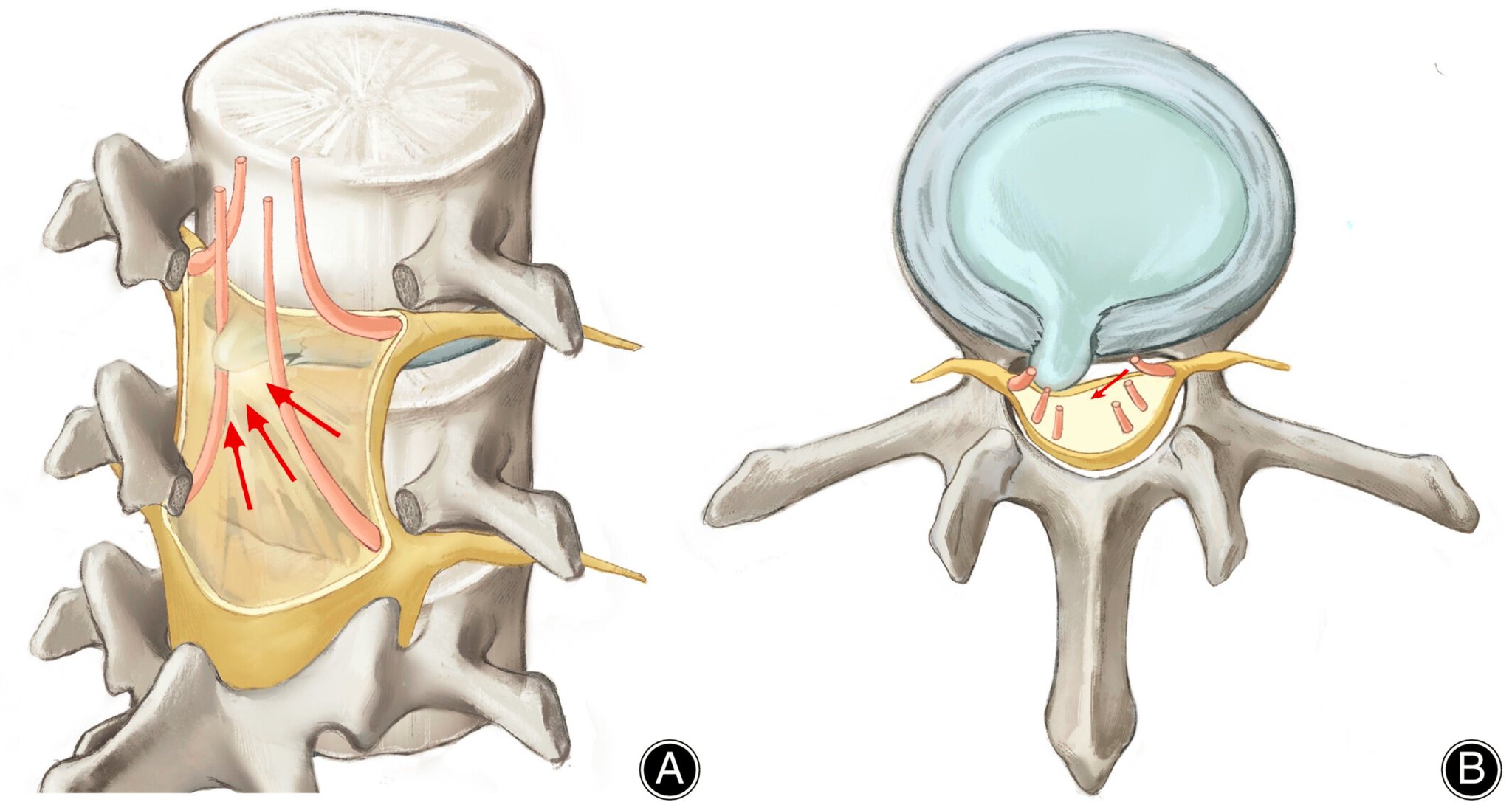 Physio - Lumbar Disc Herniation with Contralateral Symptoms: How is ...