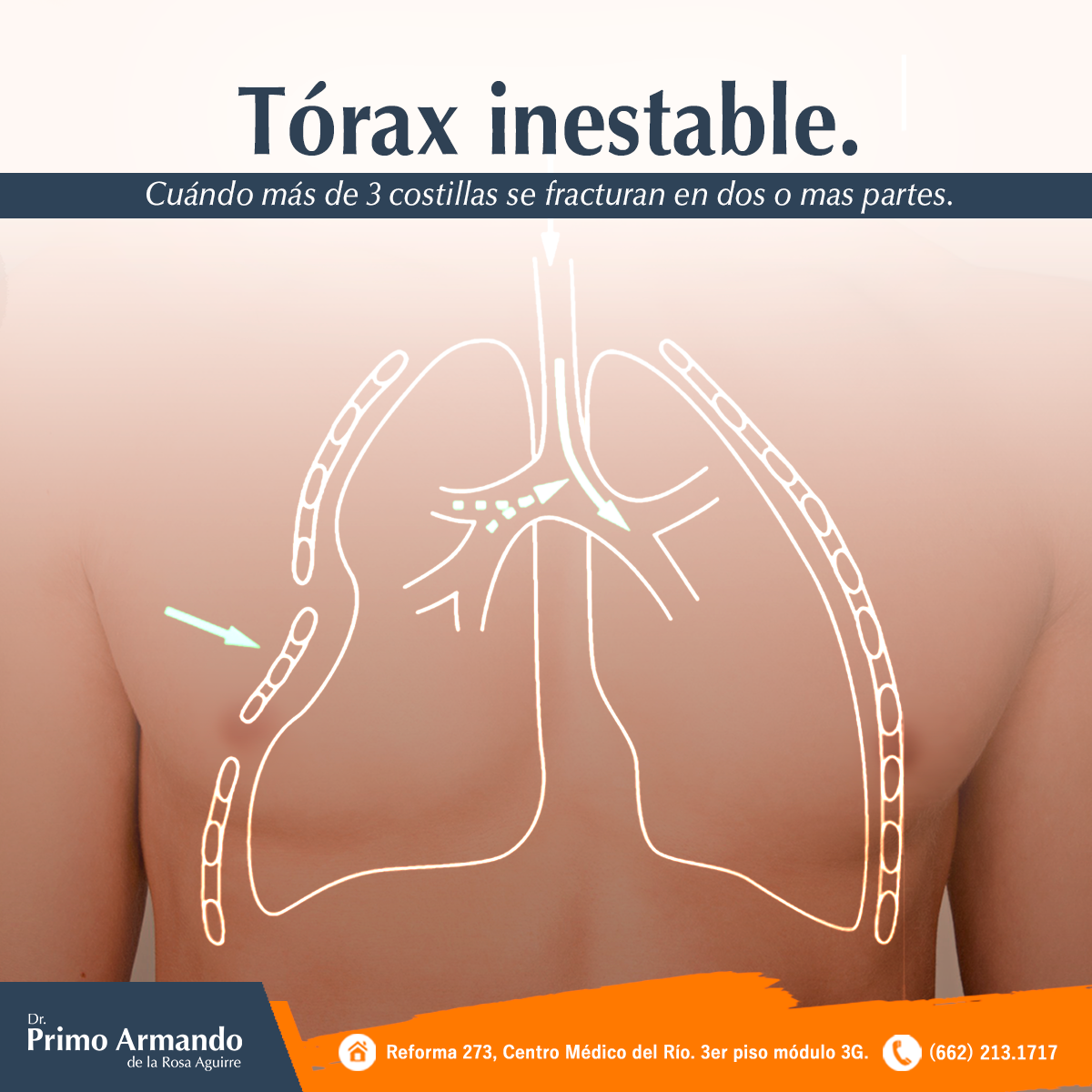 ️ El tórax inestable consiste... - Cirugía de Torax Sonora | Facebook