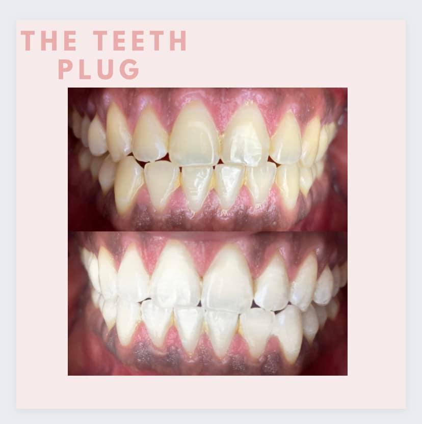 theteethplug