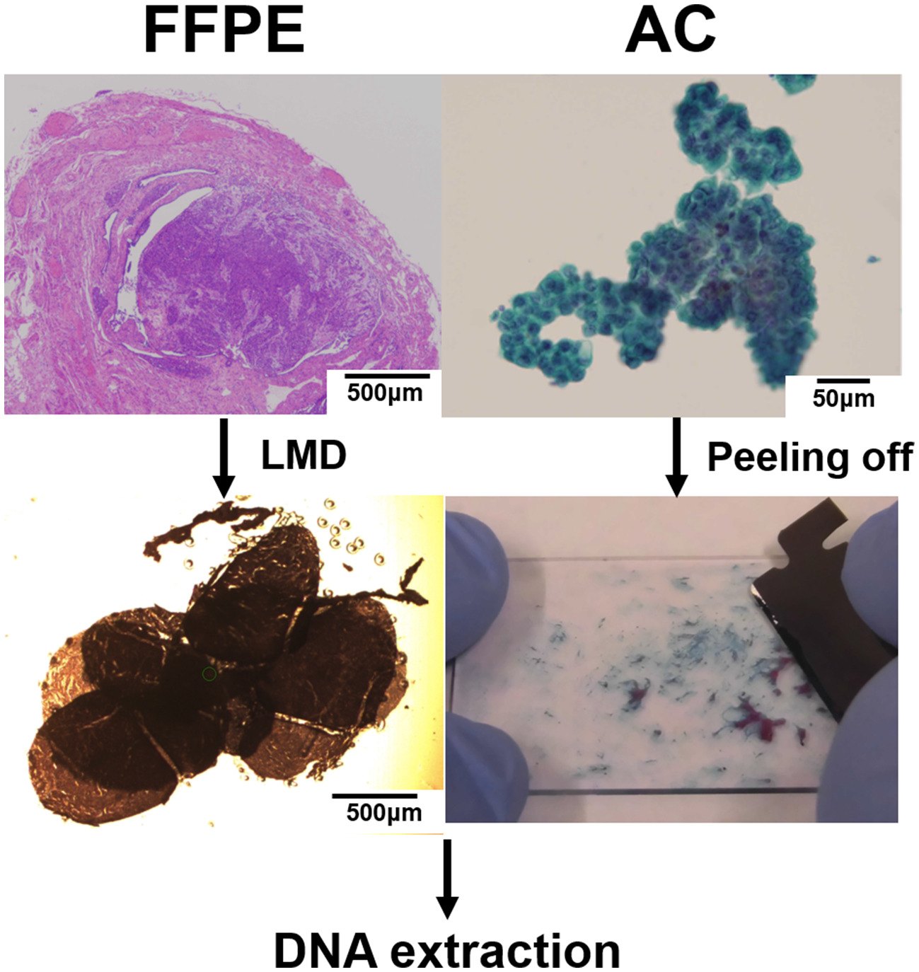 Cancer Cytopathology - Molecular analysis of ascitic fluid cytology ...
