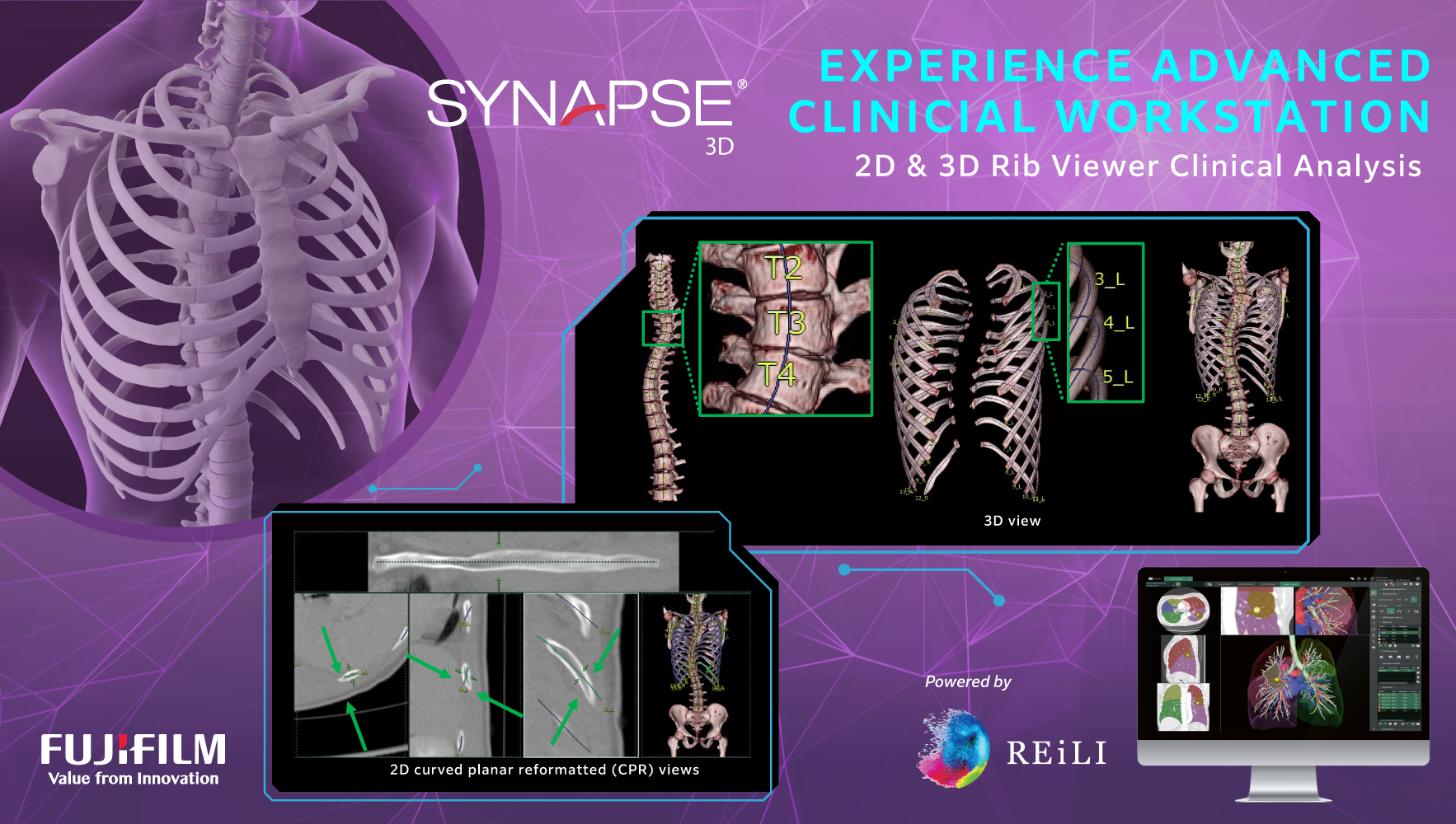 Fujifilm - 📌 #SynapseTuesday | Fujifilm Synapse 3D's Rib Viewer ...
