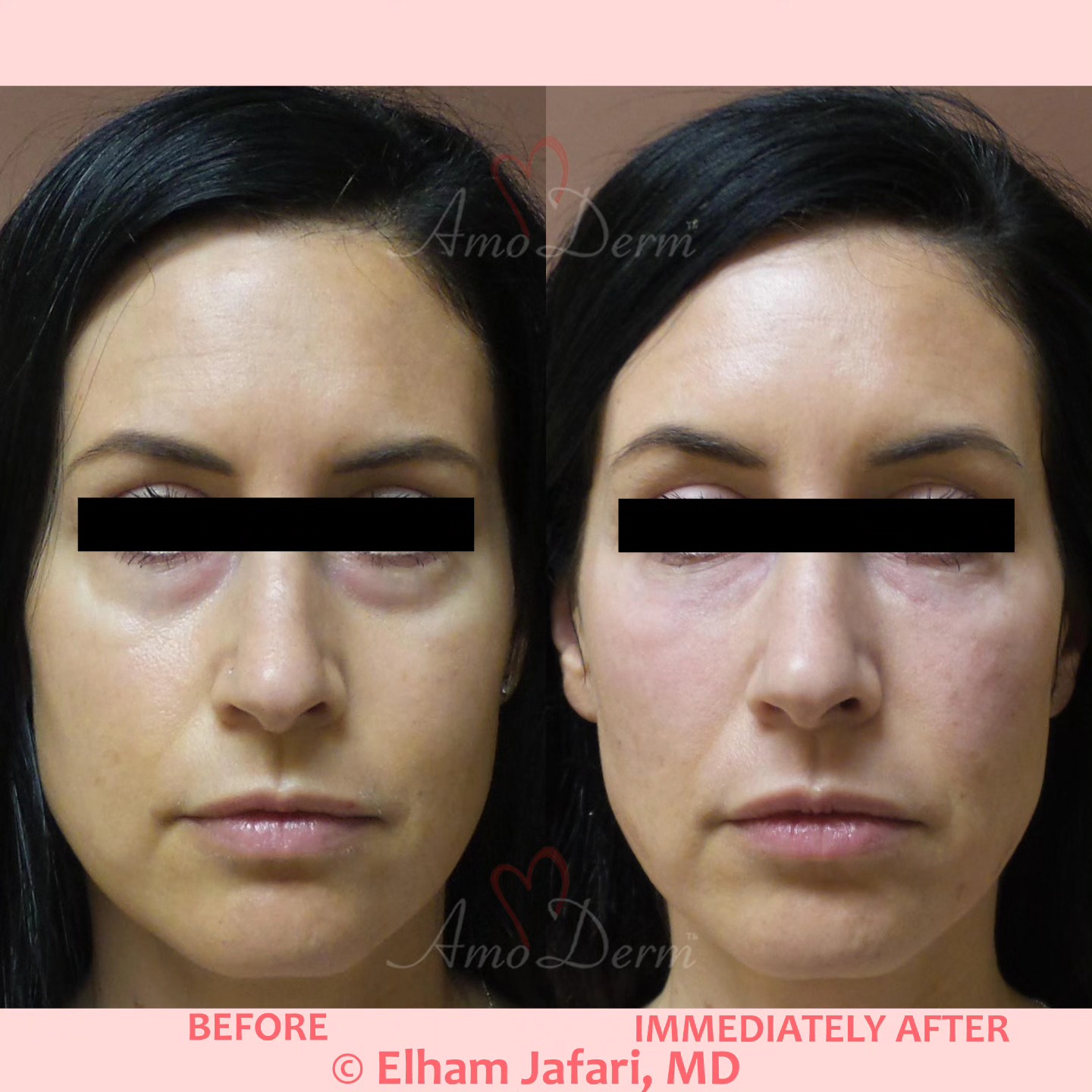 Amoderm - 👁 4D Under Eye Lift™ as part of non-surgical facelift (Liquid ...