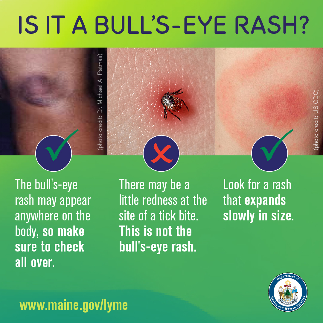 The bull's-eye rash is the most... - Maine Mosquito SWAT | Facebook