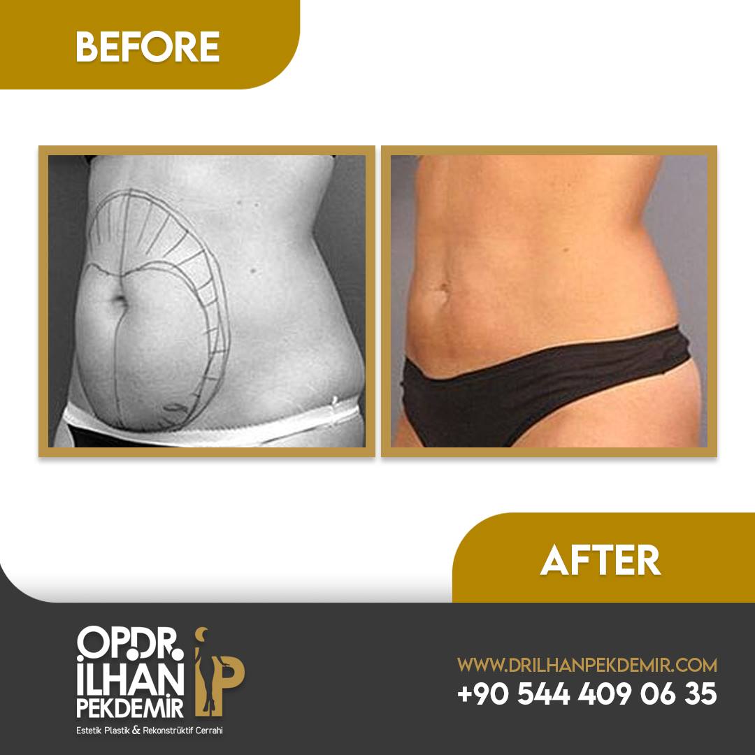 Laser liposuction... - Dr İlhan Pekdemir Estetik Cerrahi