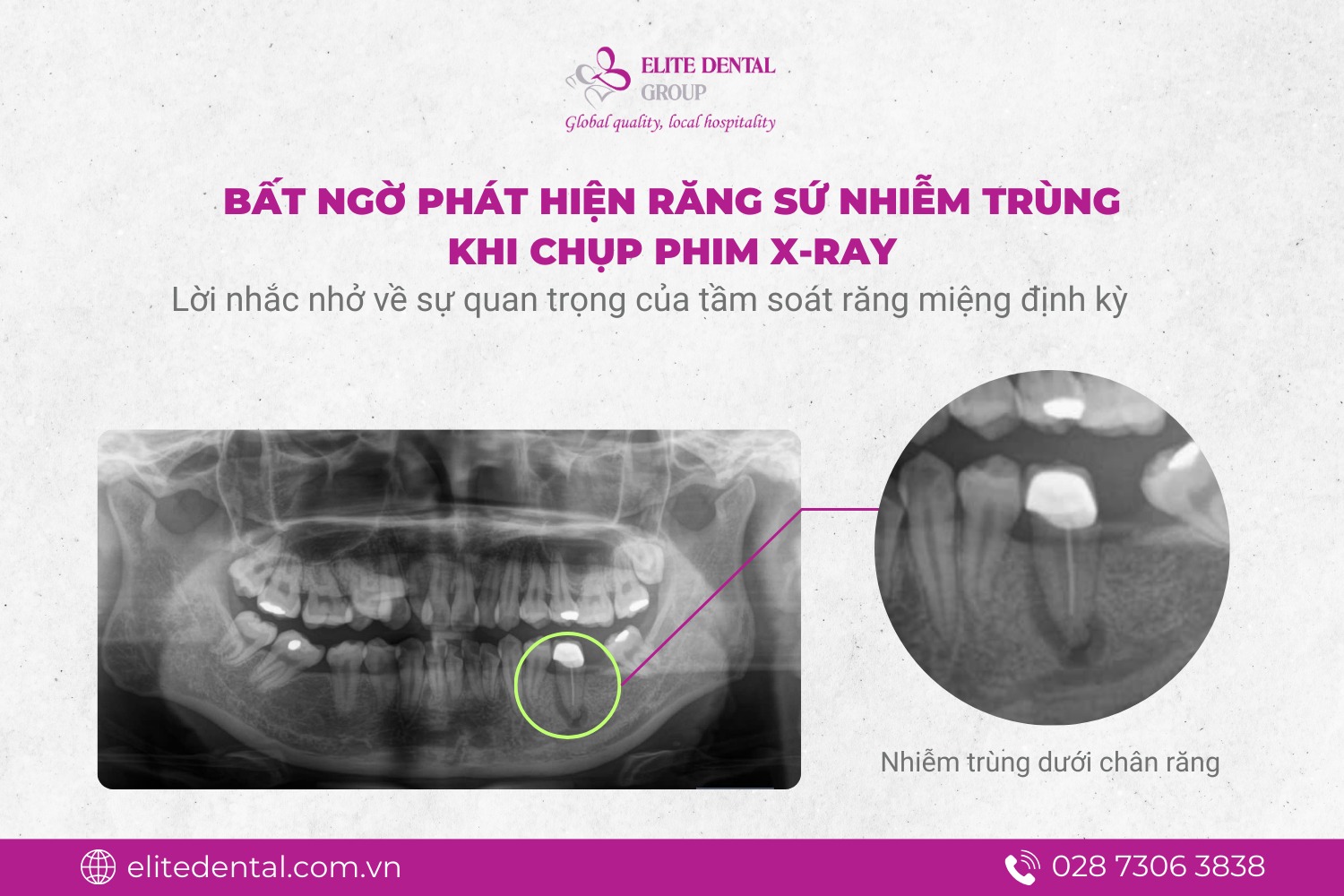 Elite - 🔎 BẤT NGỜ PHÁT HIỆN RĂNG SỨ NHIỄM TRÙNG KHI CHỤP PHIM X-RAY ...