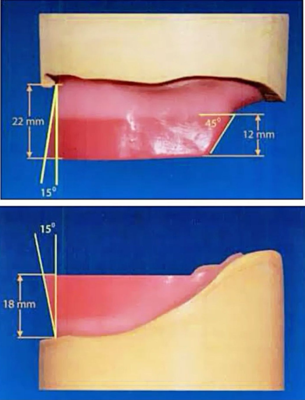 OVIdental Go - 🚫 Occlusal rims, also known as occlusal blocks or rims ...