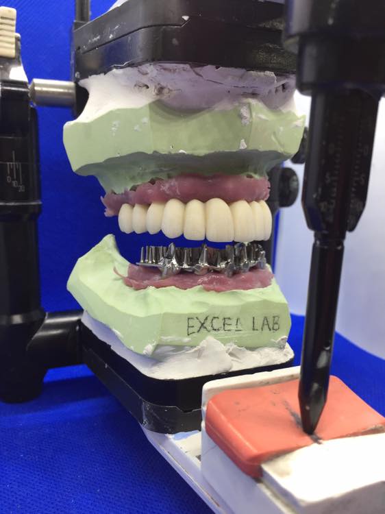 งาน PFM Implant และ งานDenture Frame... - Excel Dental Lab | Facebook