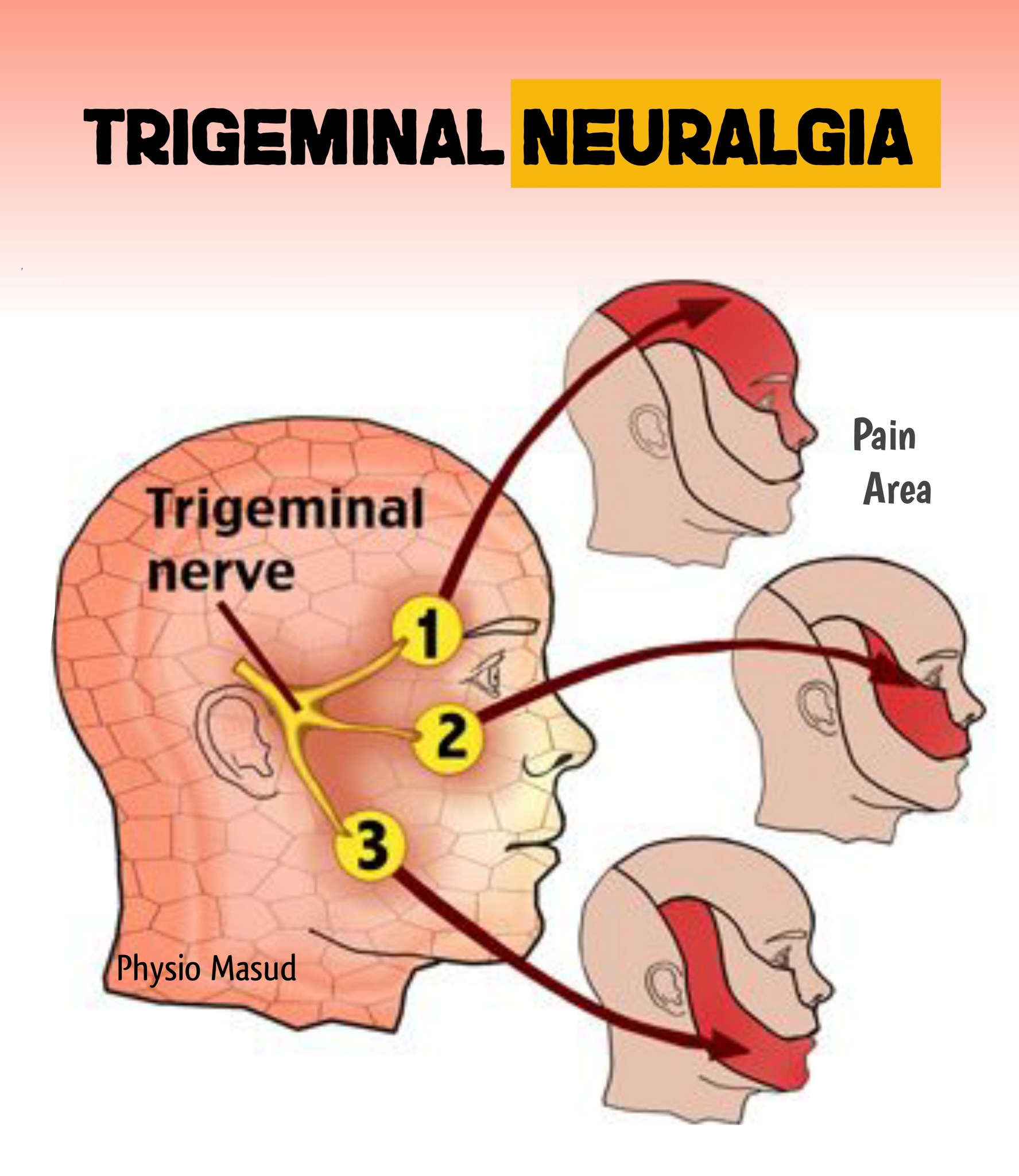 Trigeminal neuralgia (TN), also known as tic douloureux, is sometimes described as the most excruciating pain known to humanity. The pain typically involves the lower face and jaw, although sometimes
