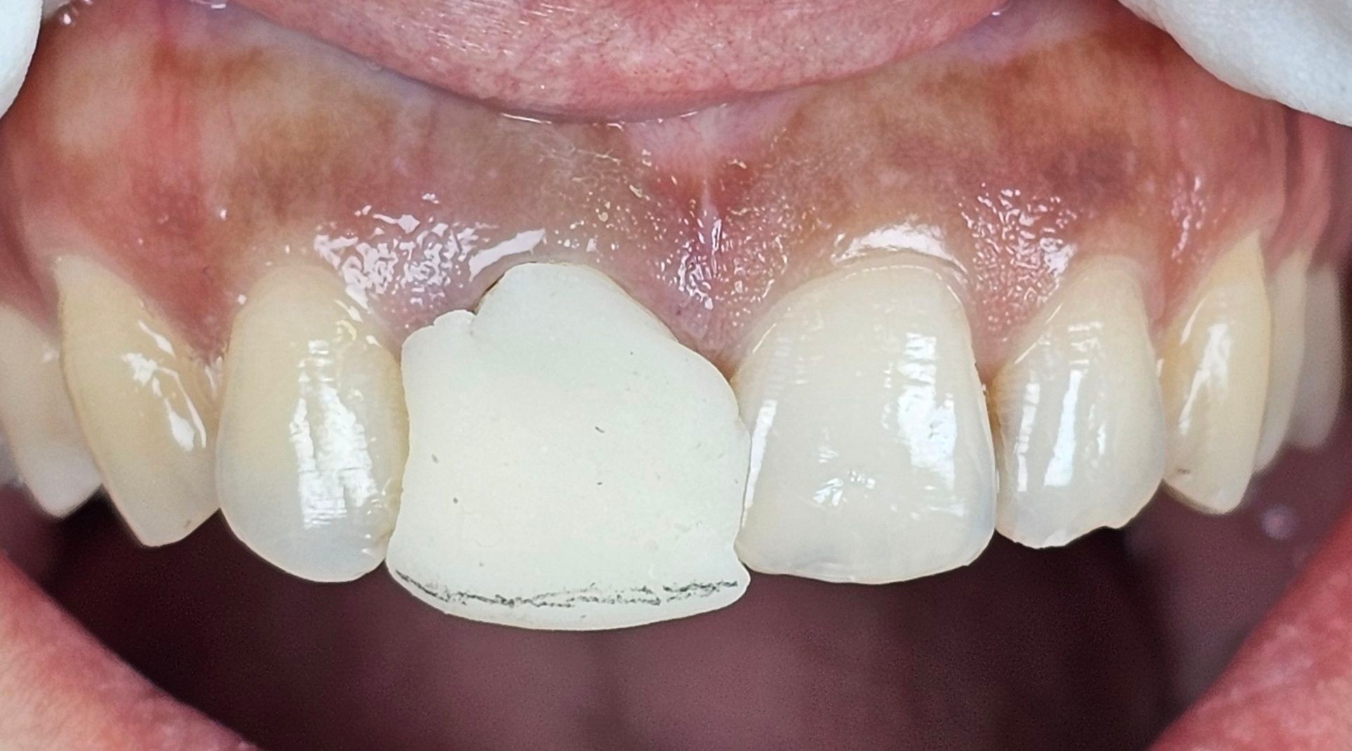 Prosthodontics For Beginners - Lack of retention ,stability and support ...