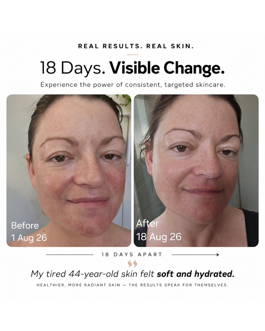 ghk-cu peptide results Derma-TX Copper Skincare Trial Review: Tracey Bruton's 18-Day Mesotherapy VITARegul® Expert (Quantité):A l'unité INFINITE AGE Sea Moss