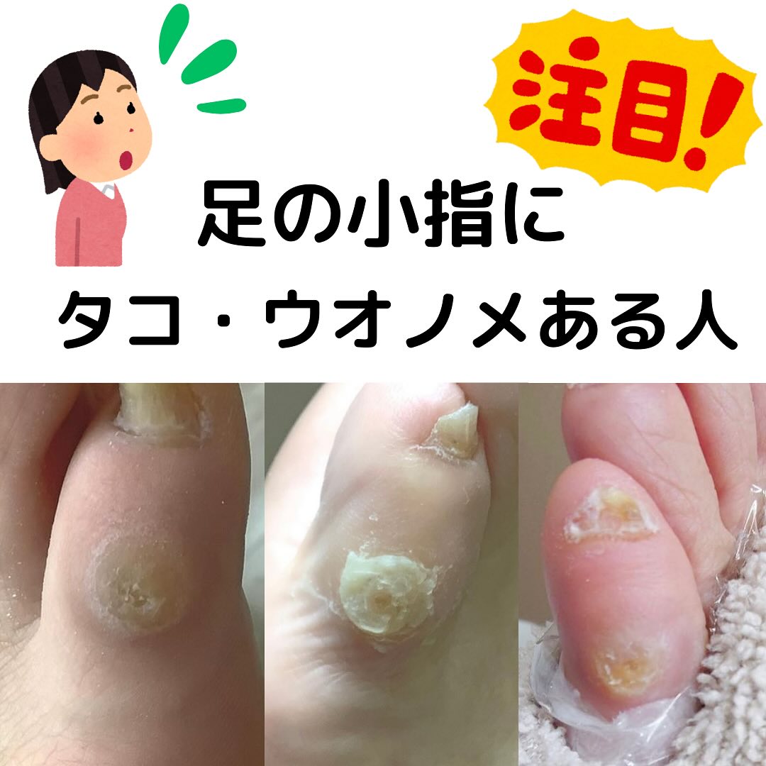 足 の 小指 タコ