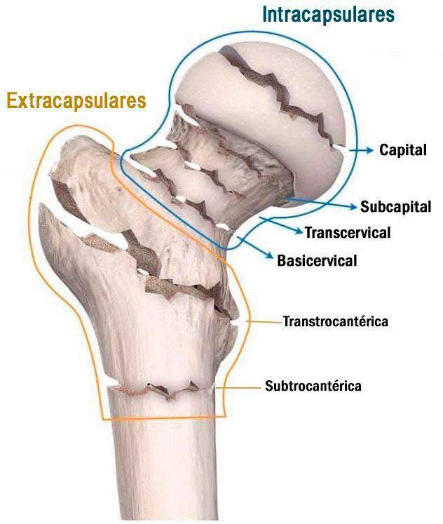 The Radiologist - This image shows different types of hip fractures ...