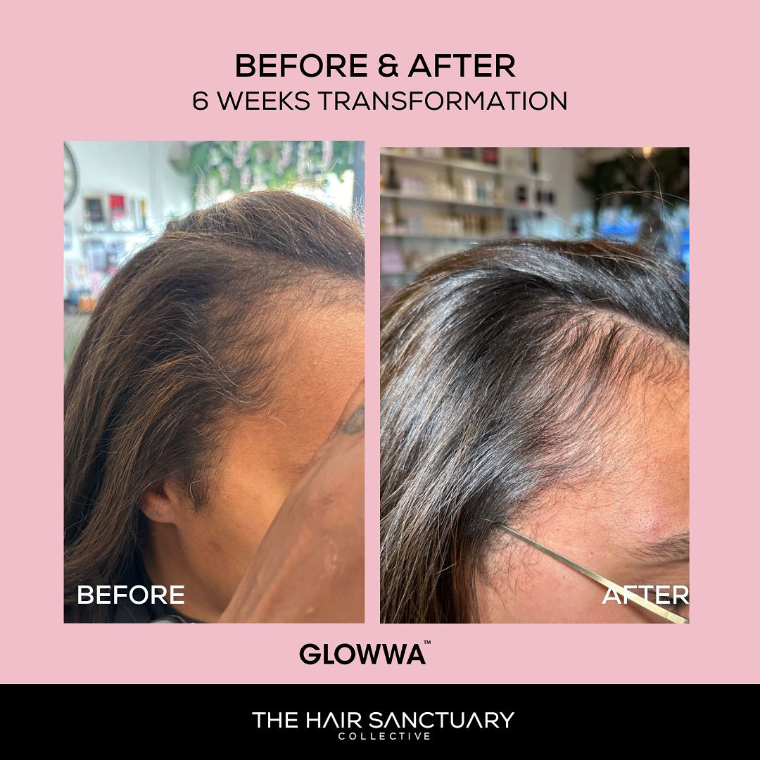 glutathione for hair growth before and after Collagen & vitamin c growth: new clinical results HK Glowup L-Glutathione Capsule for