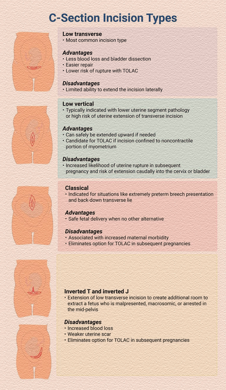🏥 C-Section Incision Types There... - Pregnancy & Parenting | Facebook
