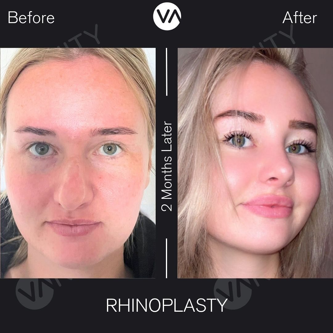can i take glutathione after rhinoplasty Important Do's and Don'ts Surgery Fast Recovery After Rhinoplasty 