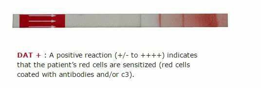 GoodLife - Direct Antiglobulin Test (DAT)หรือ Coomb's Test หรือ การตรวจ ...