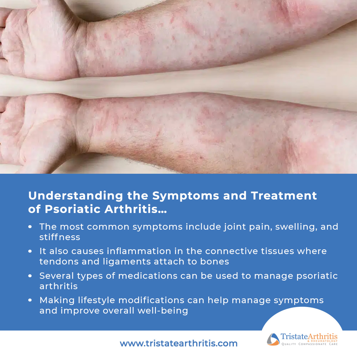 Understanding the Symptoms and Treatment of Psoriatic Arthritis… LEARN MORE... https://tristatearthritis.com/arthritis /understanding-the-symptoms-and-treatment-of-psoriatic-arthritis/ #arthritis #rheumatoidarthritis #rheumatology #arthritisdoctor 