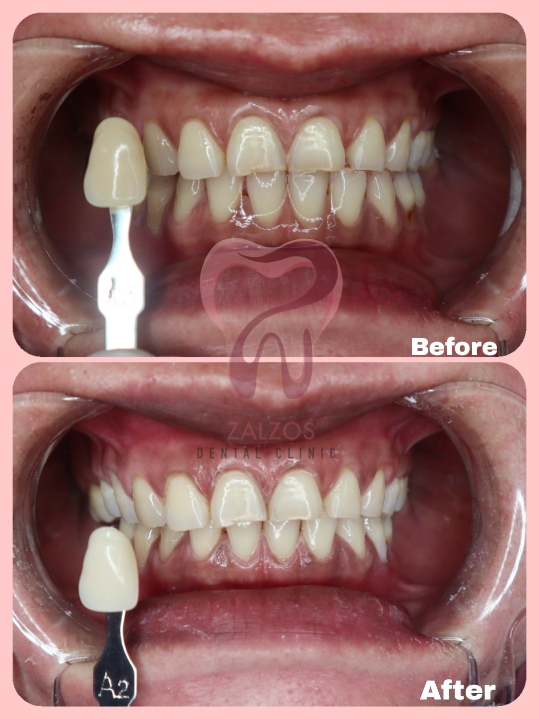 Teeth Whitening From shade... - Zalzos Dental Clinic | Facebook