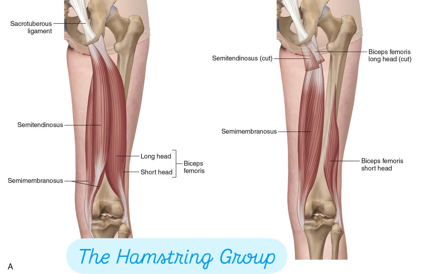 The Art - THE HAMSTRING GROUP is composed of three muscles… Two medial ...