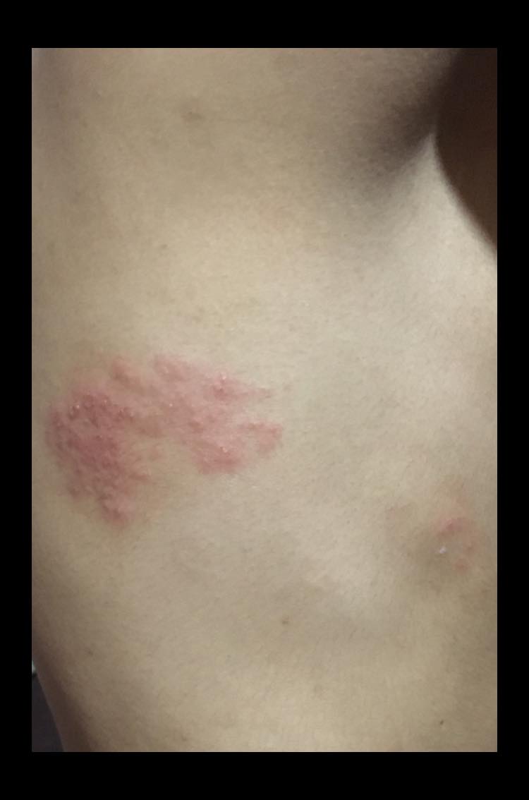 glutathione skin rash are these shingles po ba? Please help me out with this, I'm taking po should I stop it? Stress & Sleep