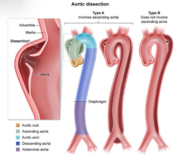 Cardiology - Risk Factors for Aortic Dissection: High Blood Pressure ...