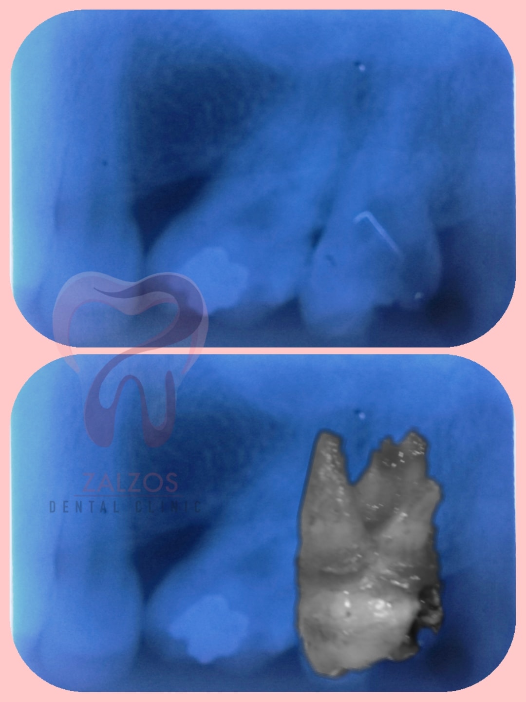 🦷 Painless Surgical Removal of a... - Zalzos Dental Clinic