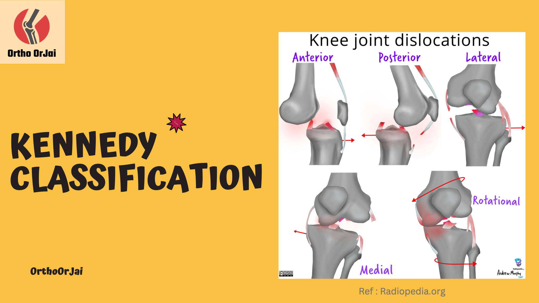 Ortho - โดย knee dislocation ก็มีการแบ่ง classification หลายแบบครับ โดย ...