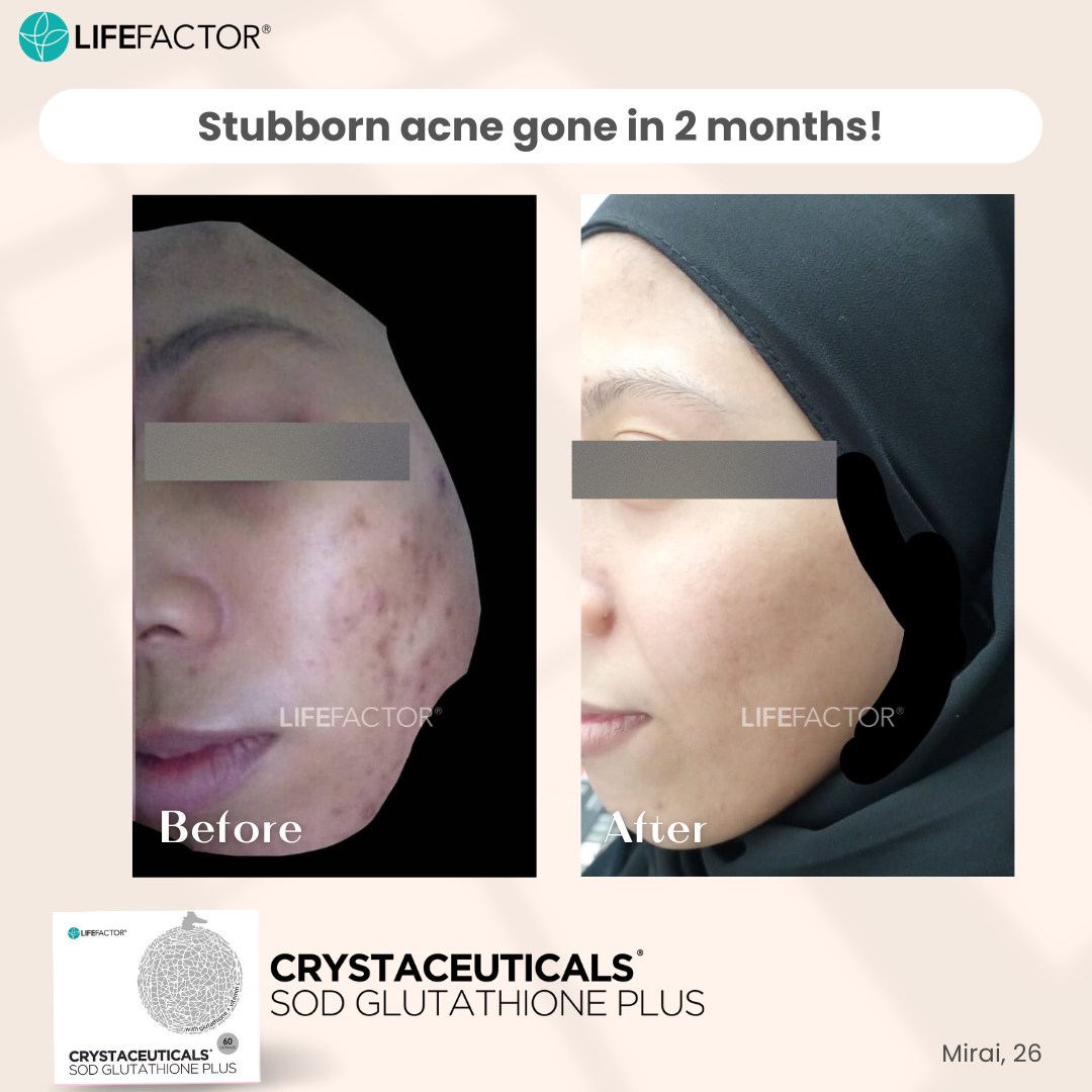 ✨𝐒𝐭𝐮𝐛𝐛𝐨𝐫𝐧 𝐚𝐜𝐧𝐞 𝐠𝐨𝐧𝐞 𝐢𝐧 𝟐 𝐦𝐨𝐧𝐭𝐡𝐬!✨ 