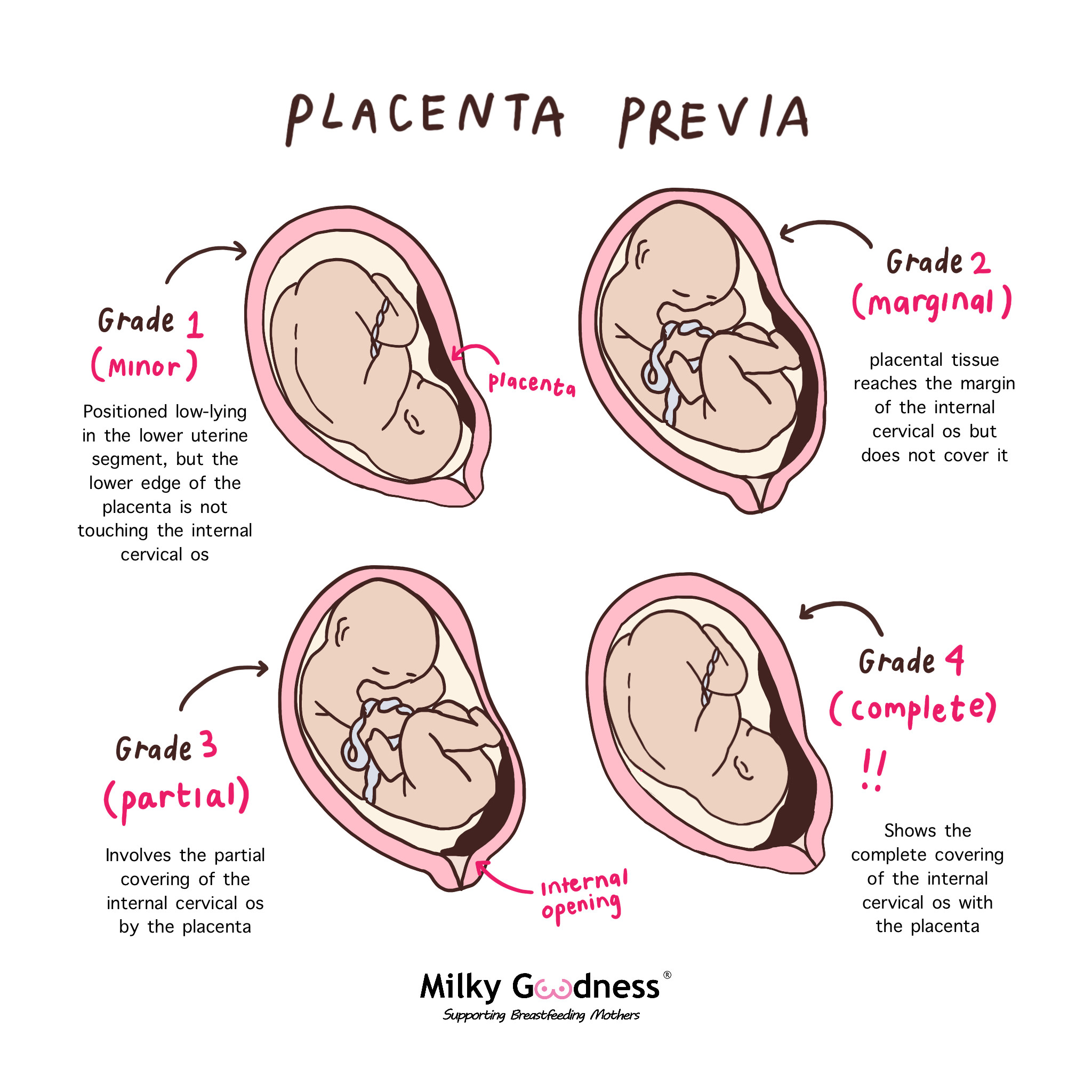 Placenta Marginal Marginal Placenta Previa Sonosession