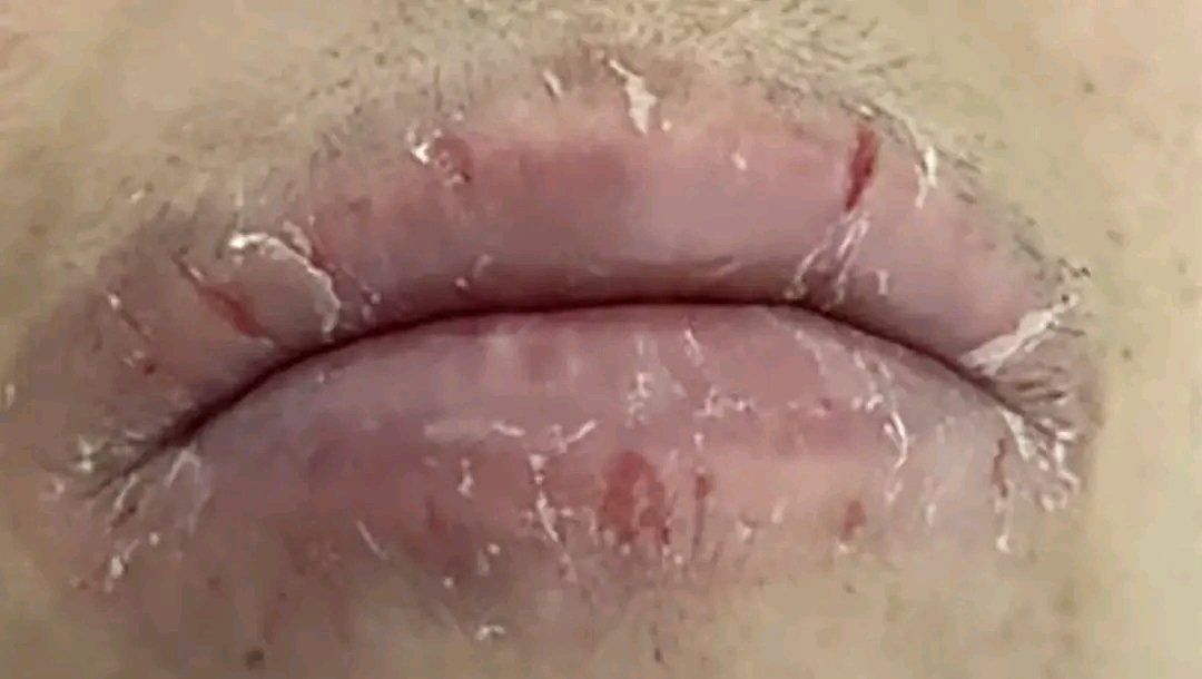 What vitamin deficiency causes cracked lips and mouth corners?
