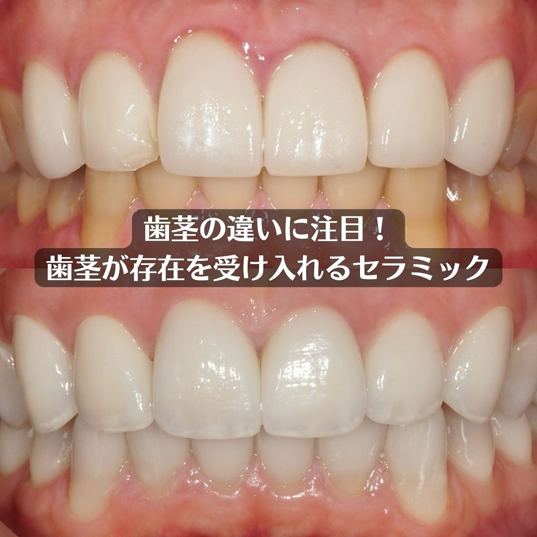 ワイズデンタルキュア - 前回の歯列矯正後の歯茎がみえるのがコンプレックスの方のお口の中です。 奥歯と上前歯はセラミック製。下の前歯は再度歯列 ...