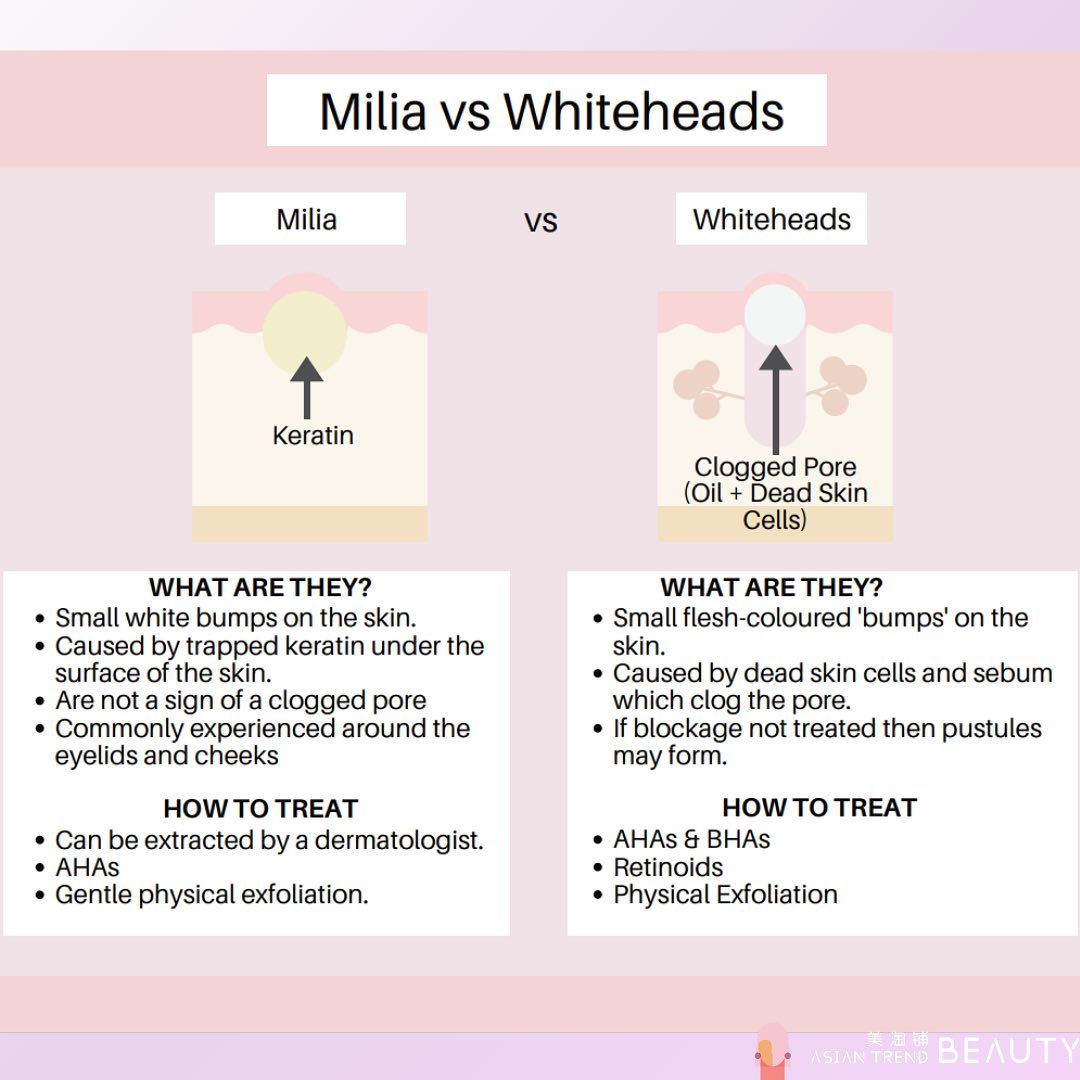 milia-vs-whiteheads-ever-asian-trend-beauty