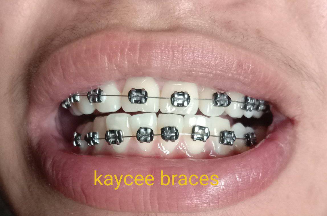 Retainer like Braces / Semi braces | Open po kame today 8am to 6pm‼️ ...
