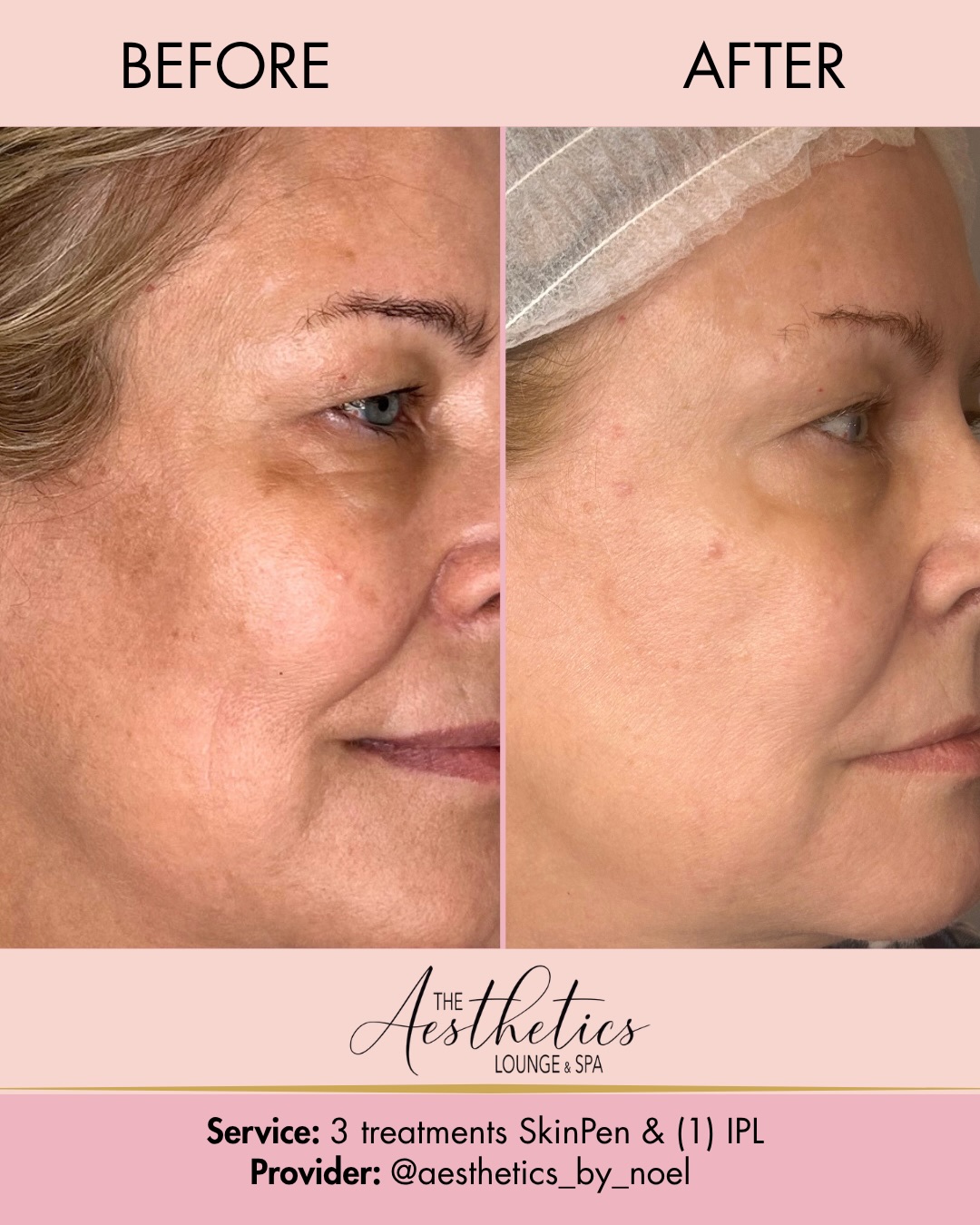 bpc 157 peptide before and after Using TB-500 BPC-157 peptides for post-surgery recovery Weight Loss Peptides - Cosmetic
