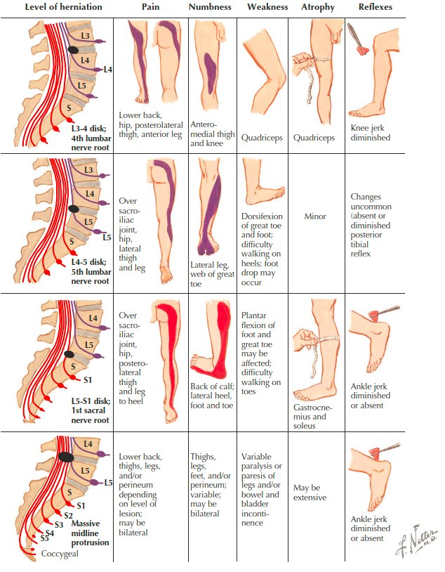 Clinical Features of Herniated... - Physio Meets Science