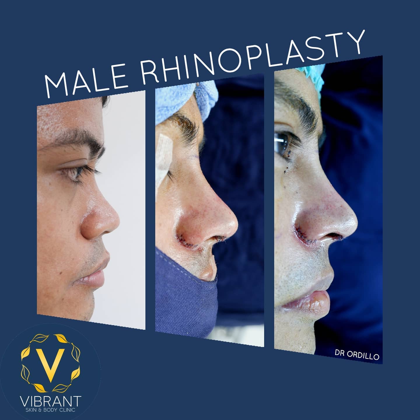 Vibrant Skin & Body Clinic by Dr. Ordillo - RINOPLASTIA EN HOMBRES ...
