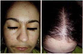الشعرانية وفرط الشعر Hirsutisme et hypertrichose Hirsutism and ...