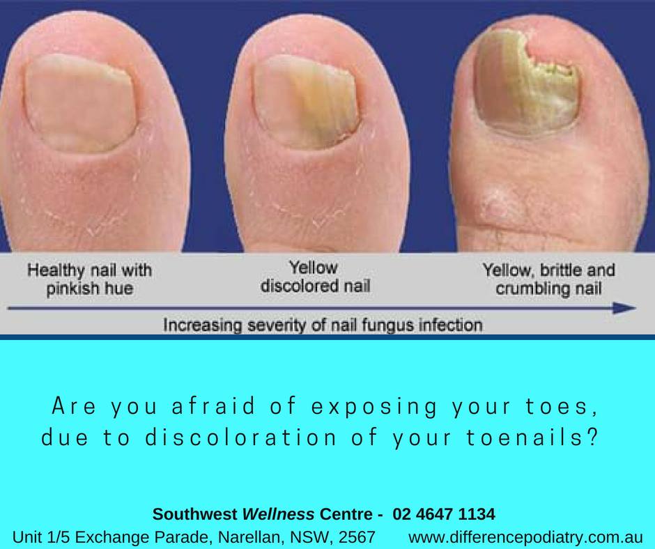 Difference - Are you afraid of exposing your toes, due to discoloration ...