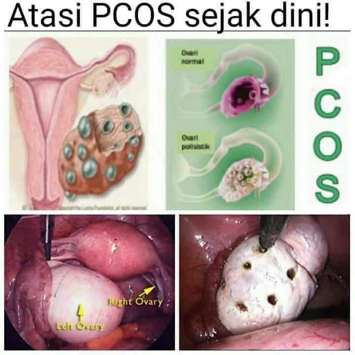 Sel Telur Kecil, Sebabkan Susah Hamil... - Obat Tradisional | Facebook