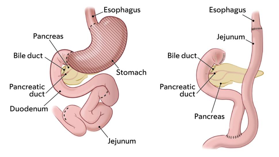 gastrectomy b12 injections In a recent study, more than 90% of people who'd had their stomach surgically removed to prevent cancer experienced a least one chronic complication 2 years out from their surgery. For some Choose Location:Mobile Services - All of New York City and Long Island New COVID vaccine restrictions Ipamorelin: