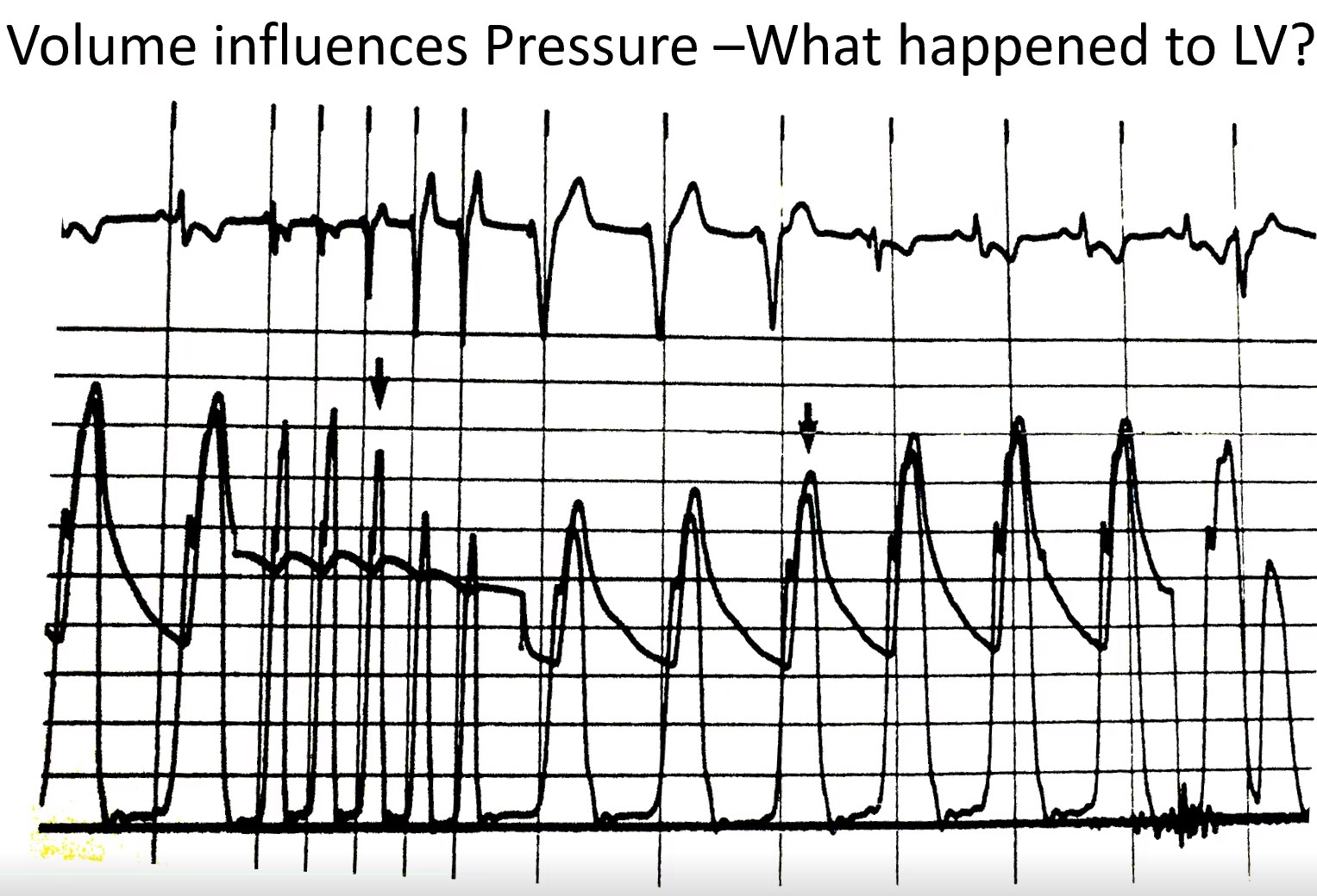 Wondr Medical - What causes the sudden drop in aortic... | Facebook
